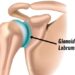 Glenoid Labrum Tear