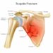 Scapula Fractures